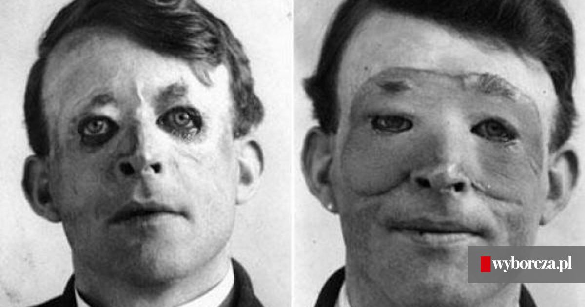 Warsztat blaszanych nosów. Harold Gillies był pionierem chirurgii plastycznej - z30833417fbwmarynarz-walter-przed--po-lewej--i-po-rekonstrukcj.jpg